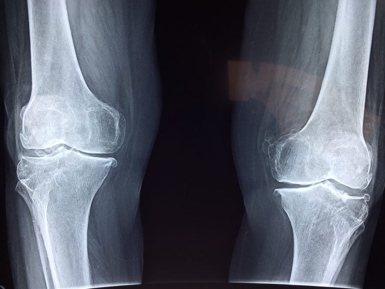 Knee osteoarthritis is getting alarmingly common. Image of knee x-ray.