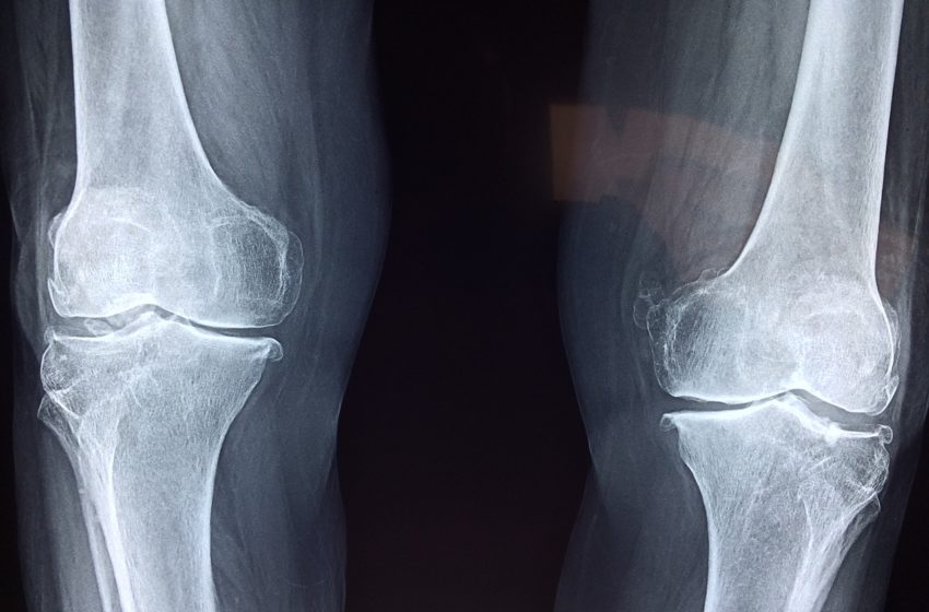 Knee osteoarthritis is getting alarmingly common. Image of knee x-ray.